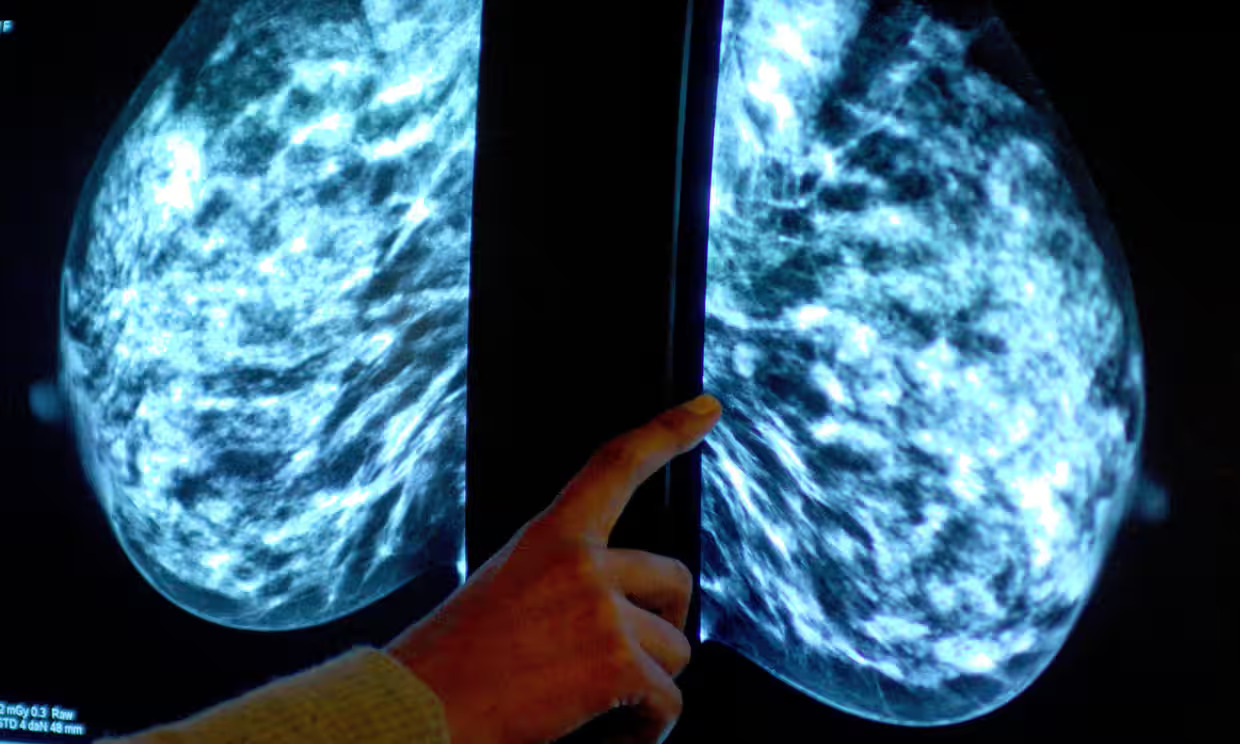 NHS Launches Groundbreaking AI Trial for Breast Cancer Diagnosis